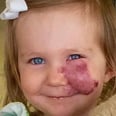 When This Child Noticed Kids Staring at Her Birthmark, She Owned It in an Incredible Way