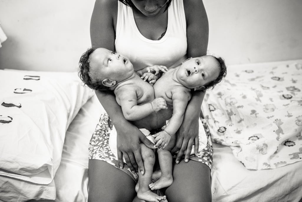 Photographer Captures the Beauty of Conjoined Twins