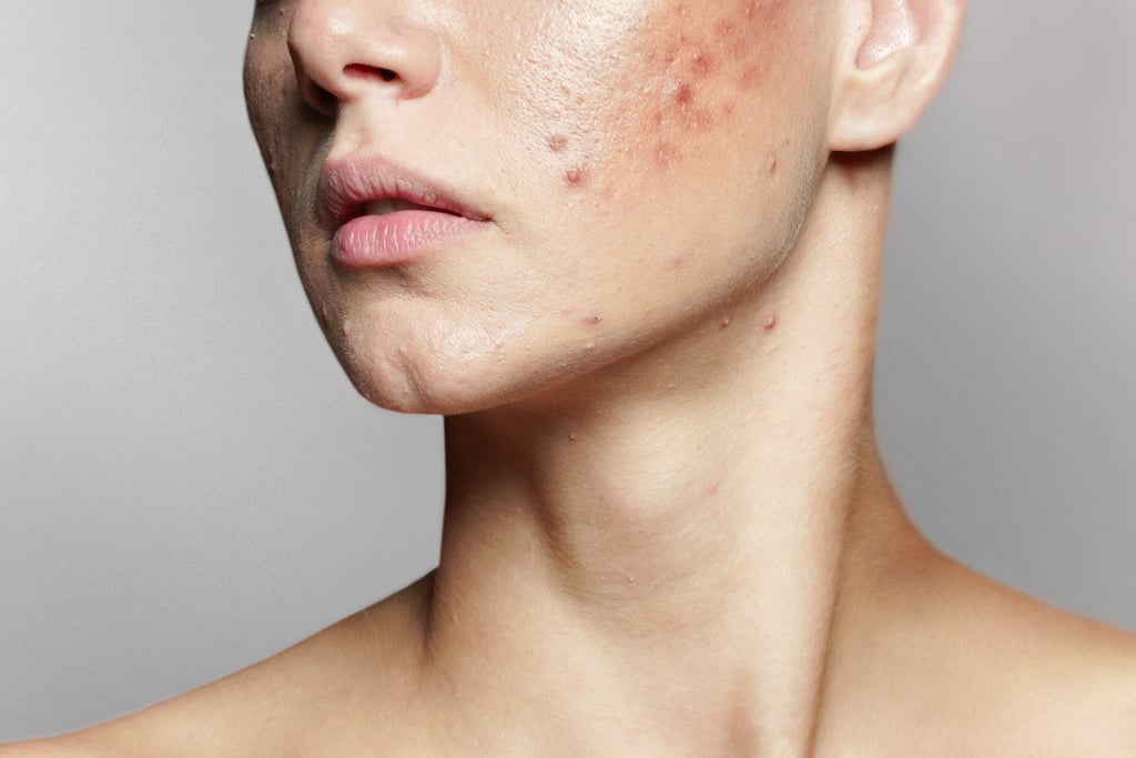 Experts Recommend the Best Acne Treatments For a Flare Up