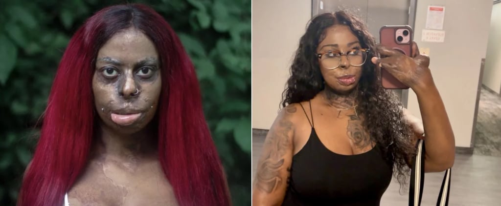 A Woman Is Reclaiming Her Burn Scars With Tattoos: Essay