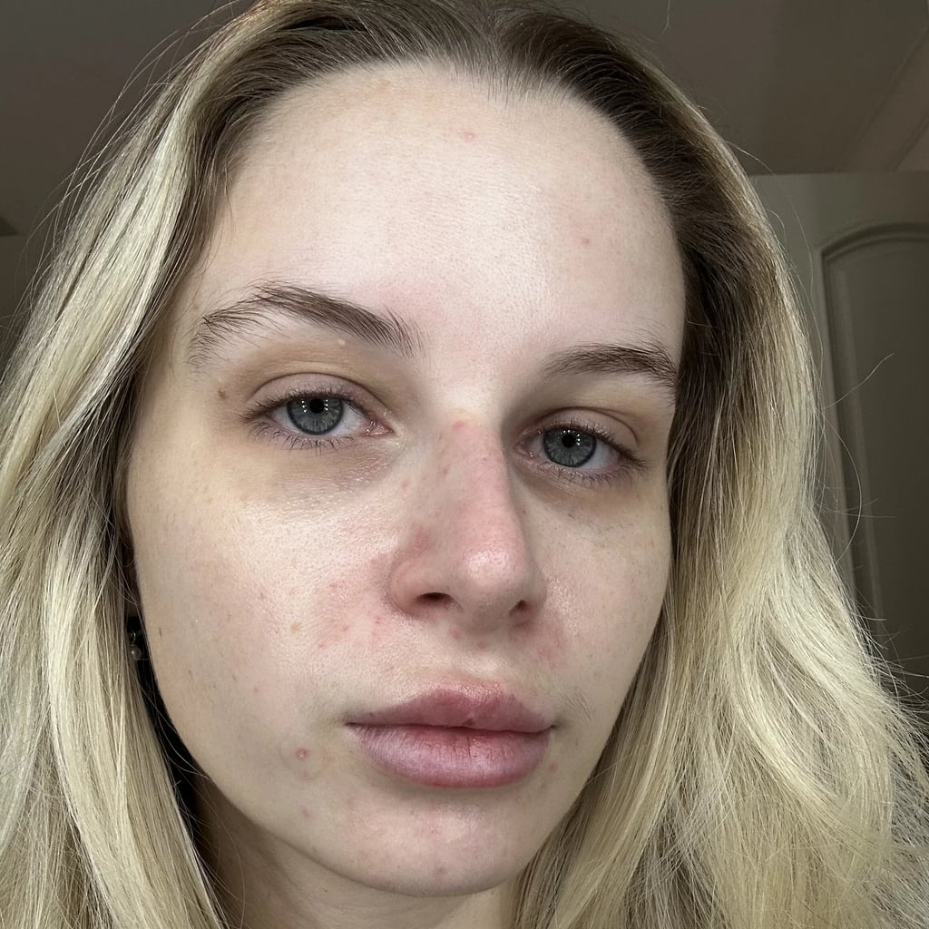 Differin AcneProne Skin Patches Review With Photos POPSUGAR Beauty UK