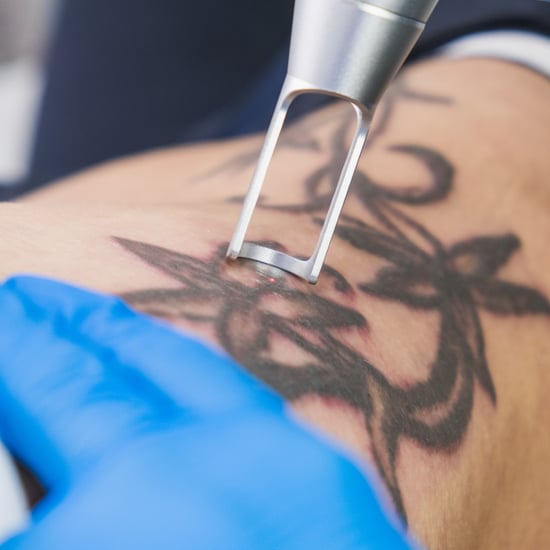 Does Tattoo Removal Hurt?