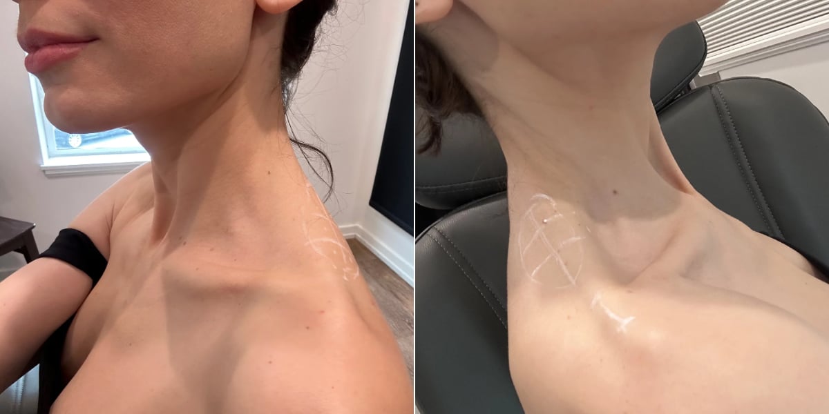 Plastic surgeon weighs in on beauty trend 'traptox' - which sees