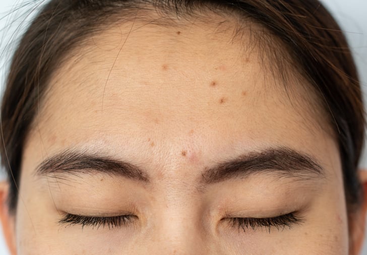 Forehead Breakouts Determining Acne Causes Using Face Mapping