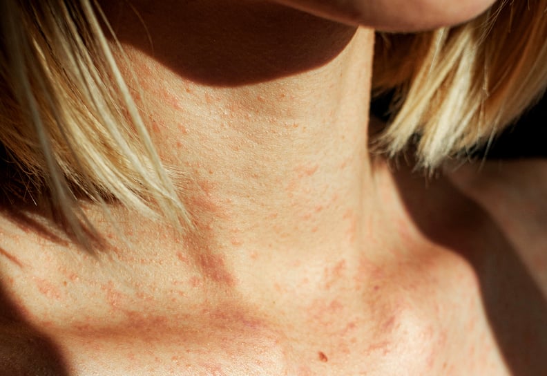 difference between hives vs. rash