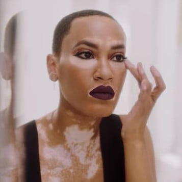Amy Deanna Vitiligo Cover Girl Model