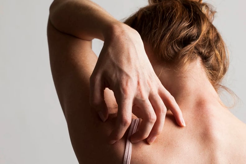 Eczema vs. Psoriasis