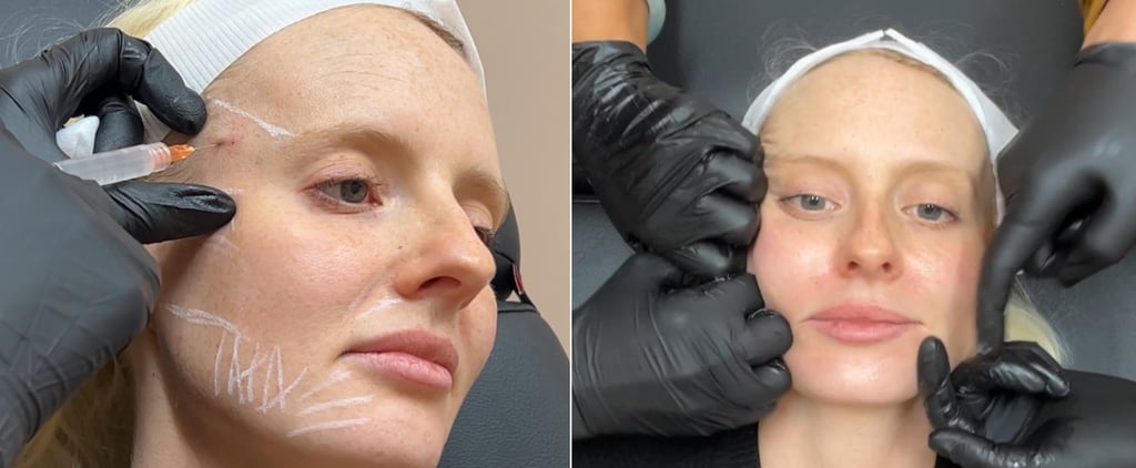 I Tried Sculptra: See Before and After Photos