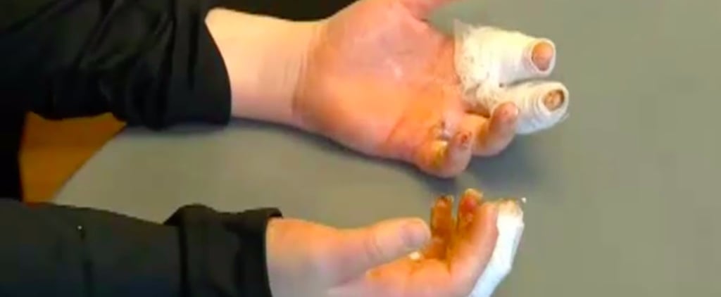 Third-Degree Burns From Slime