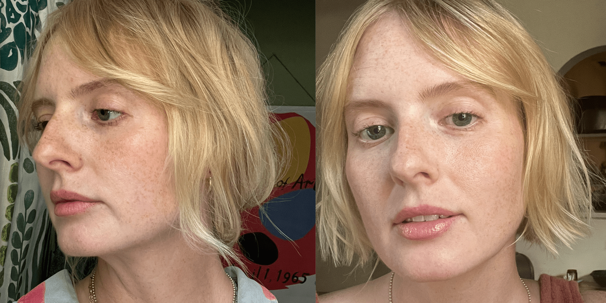 I Tried Ellacor Skin-Tightening Treatment: See Photos - Vimarsana News