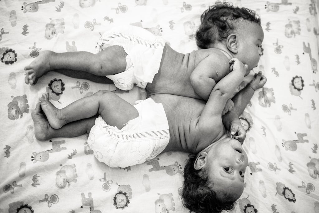 Photographer Captures the Beauty of Conjoined Twins