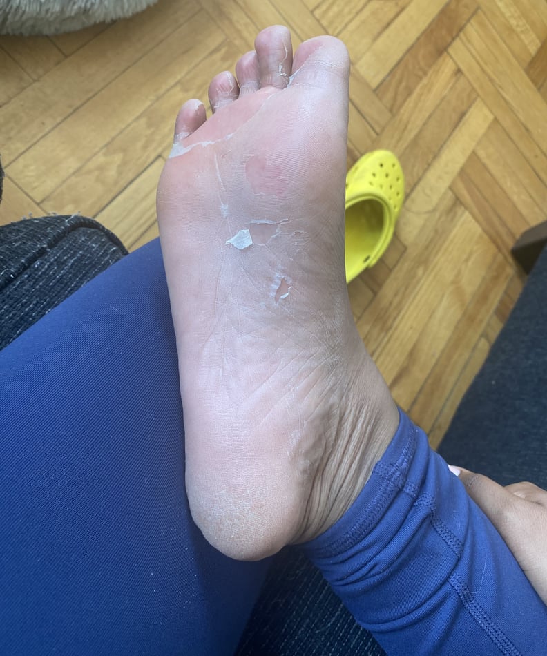 Baby Foot Peel: I Tried It And Here's What Happened