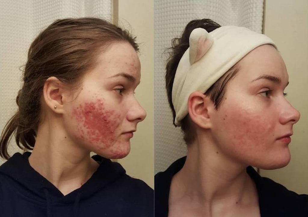 does accutane work hormonal acne