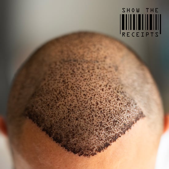 Show the Receipts: How Much It Costs For a Hair Transplant