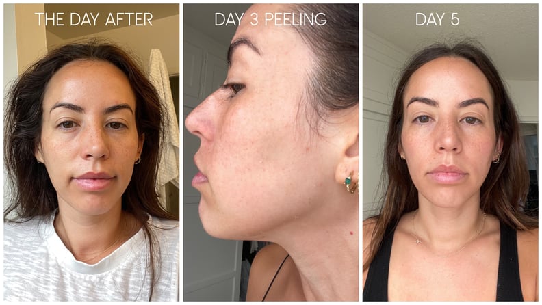 Liquid Microneedling Editor Experiment