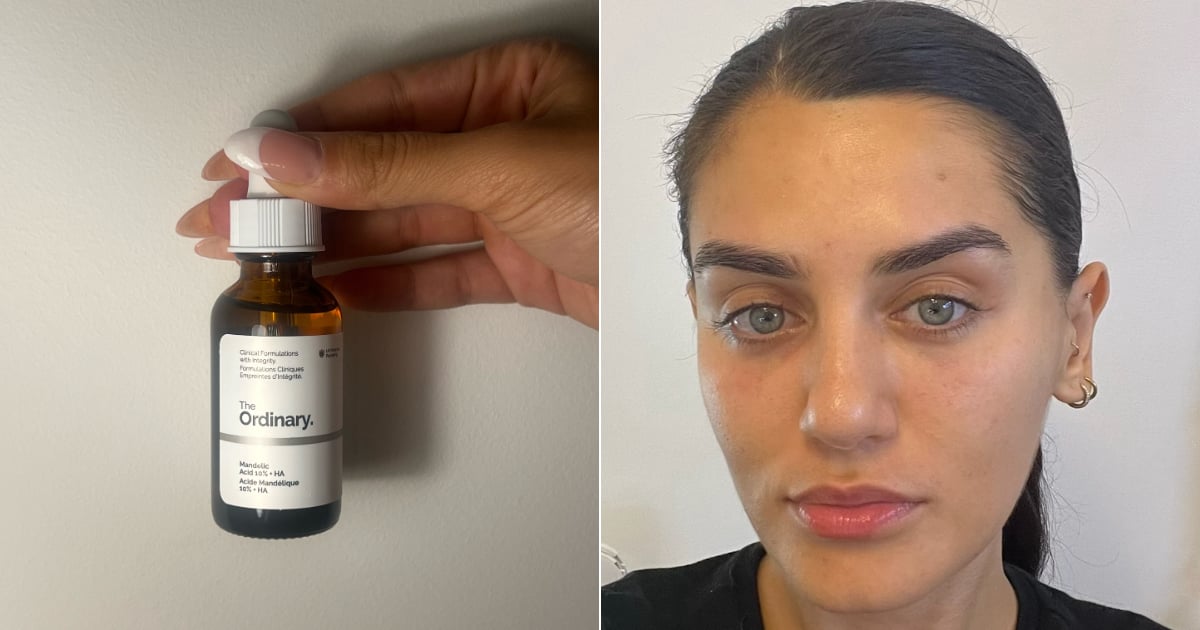 This  Serum Transformed My Acneic Skin In Just 7 Days