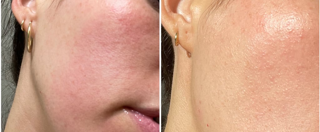 What Is Contact Dermatitis? Here's What to Know About the Skin Condition