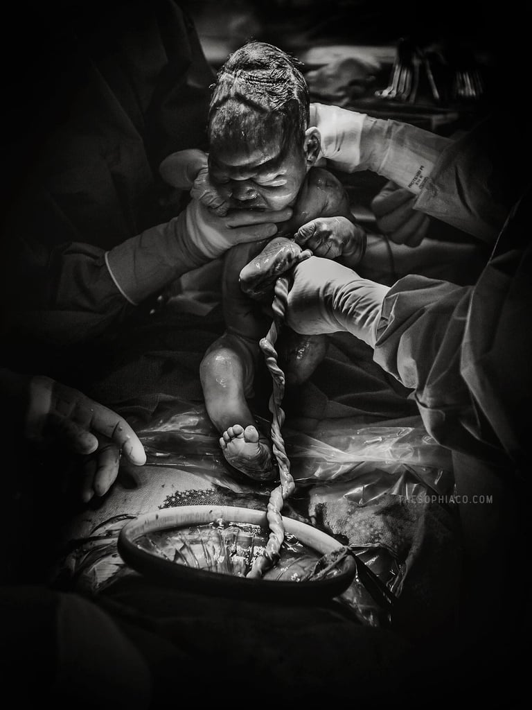C-Section Birth Photography