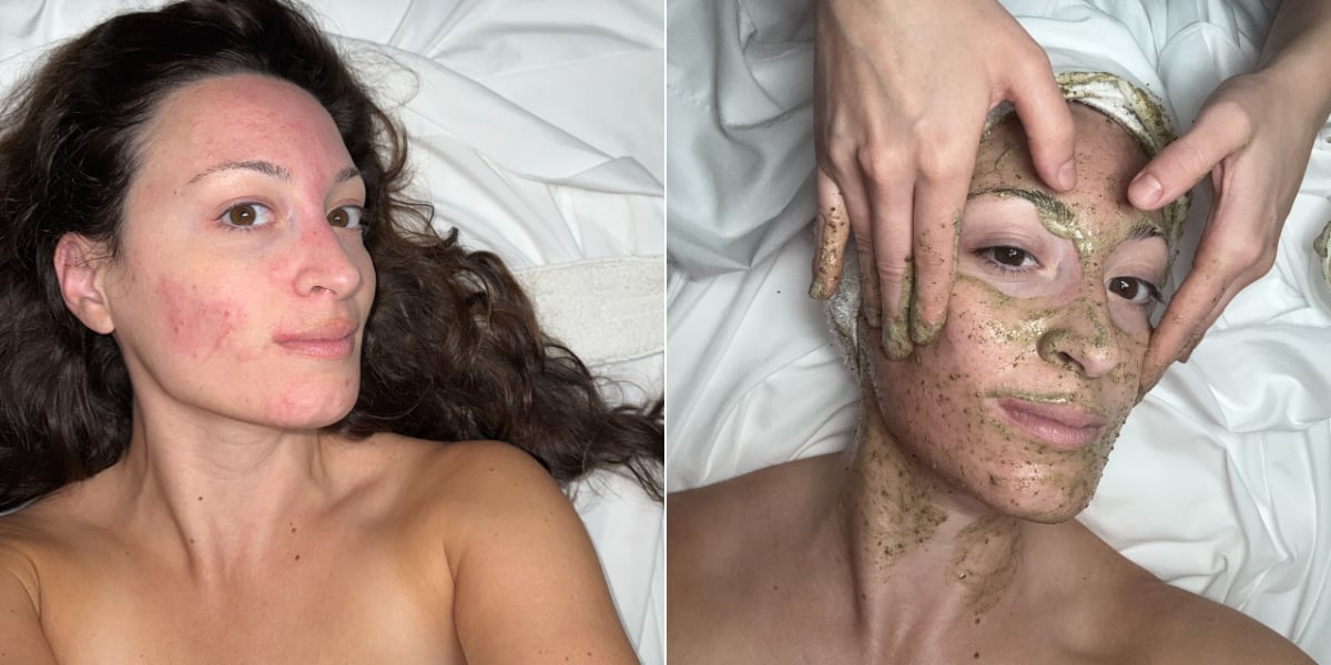 I Tried a "Fiberglass Facial," and It Made My Skin Look So Good