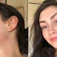 I Never Had Acne as a Teen, but My Breakouts Got Out of Control When I Turned 22
