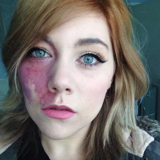 Woman With Birthmark Told She Is Undateable