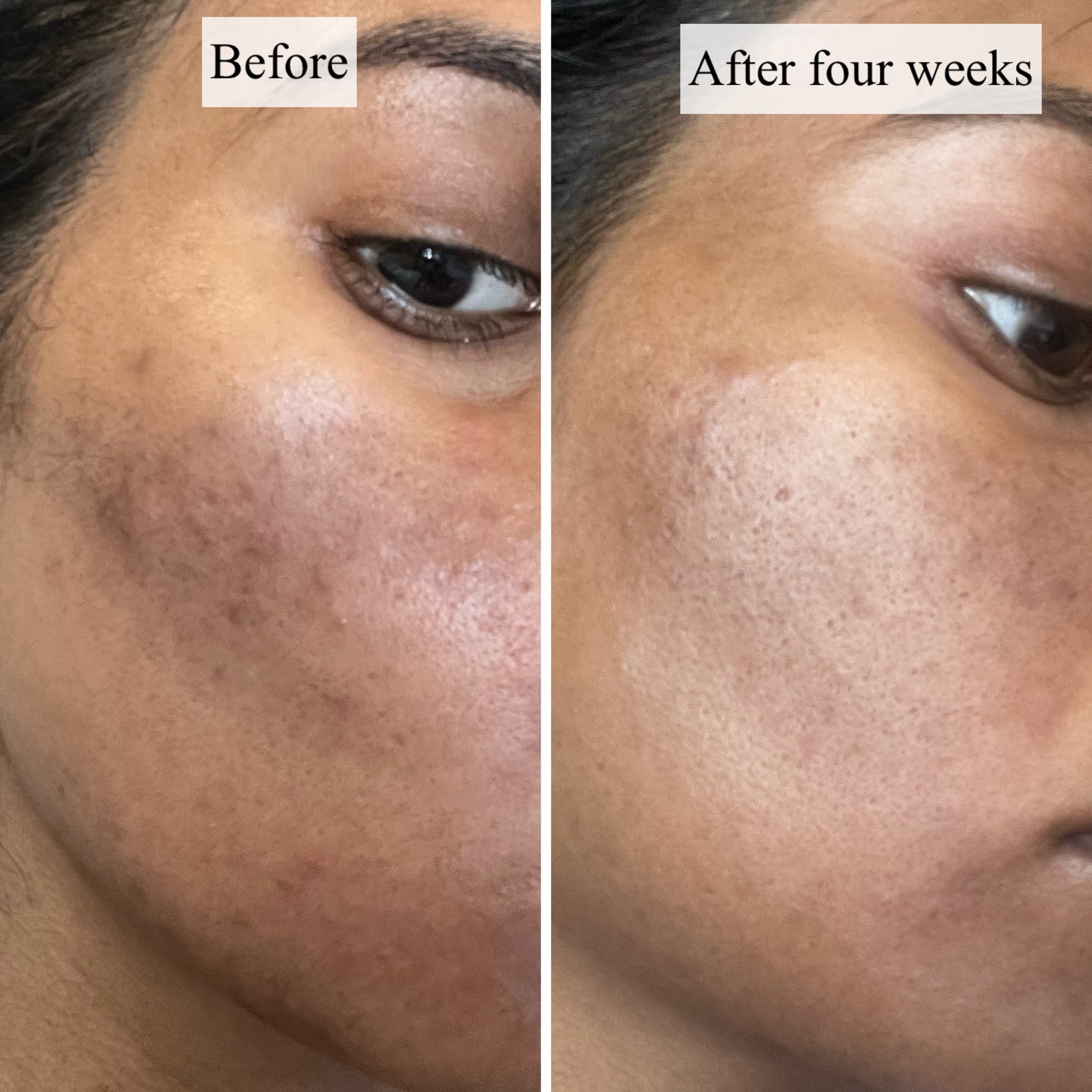 Before and after using the Remedy For Dark Spots for four weeks.