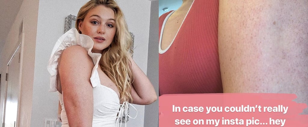Iskra Lawrence Opens Up About Keratosis Pilaris on Instagram