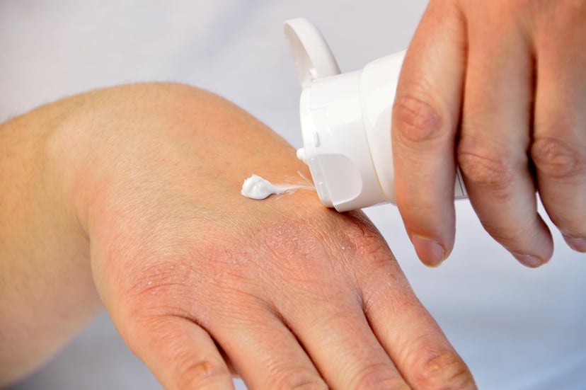 Cropped image of a young woman putting moisturizer onto her hand with very dry skin and deep cracks with cream.