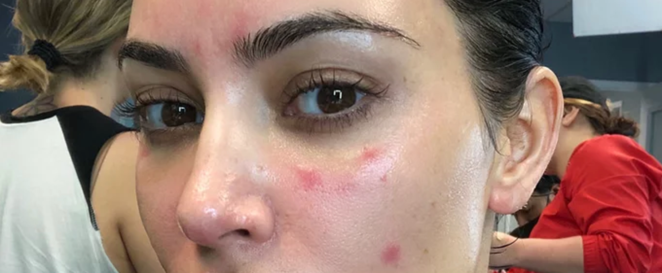 Kim Kardashian Just Wrote 1,000 Words on Her Battle With Psoriasis, Sharing Never-Before-Seen Photos